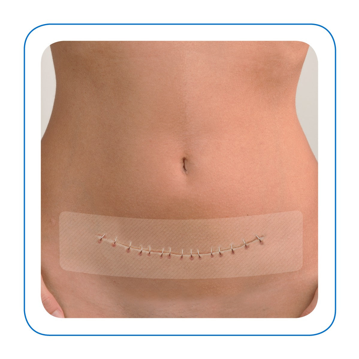 Covalon | SurgiClear® | Cobertor